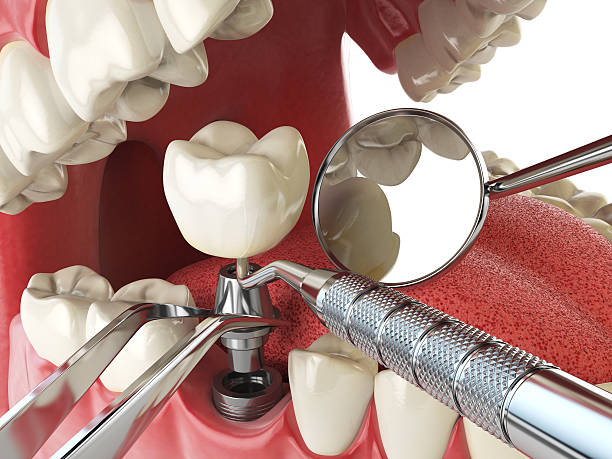 Best Knocked-Out Tooth (Avulsed Tooth) Treatment in Morganfield, KY